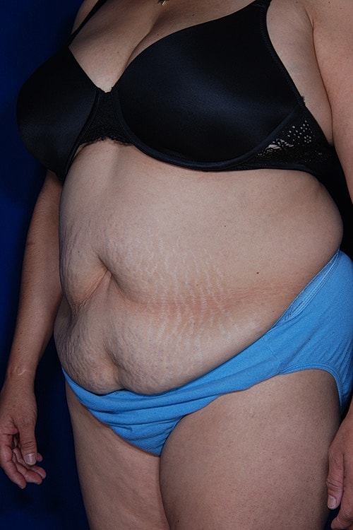 Tummy Tuck Before & After