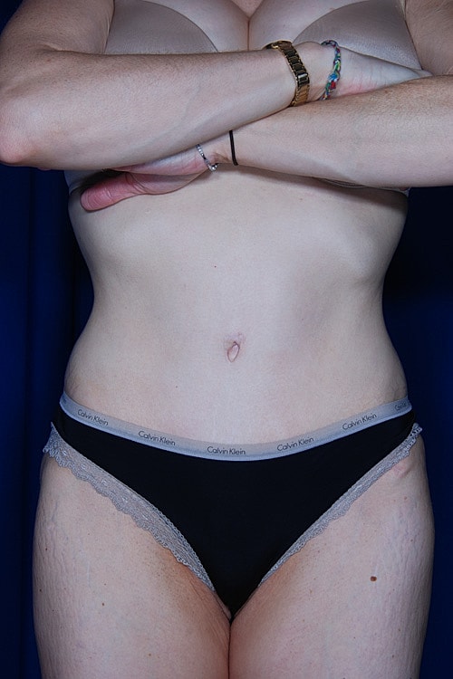 Tummy Tuck Before & After