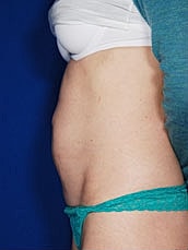 Tummy Tuck Before & After