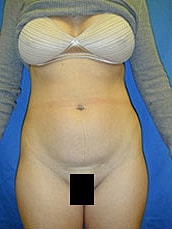 Tummy Tuck Before & After