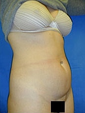 Tummy Tuck Before & After