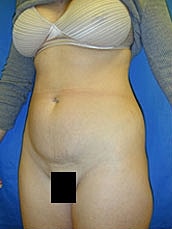 Tummy Tuck Before & After