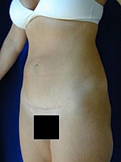 Tummy Tuck Before & After