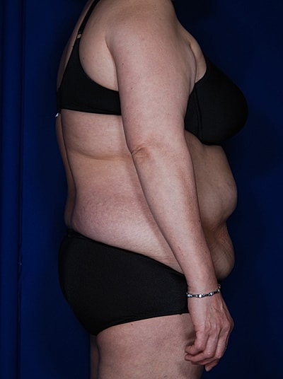 Tummy Tuck Before & After