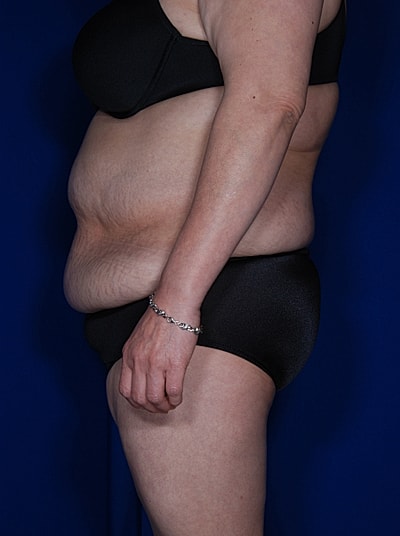 Tummy Tuck Before & After