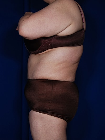 Tummy Tuck Before & After