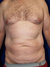 Male Abdominoplasty Before & After