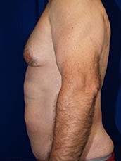 Male Abdominoplasty Before & After