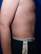 Male Abdominoplasty Before & After