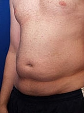 Male Abdominoplasty Before & After