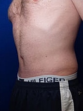 Male Abdominoplasty Before & After