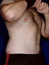 Male Abdominoplasty Before & After