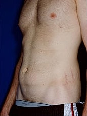Male Abdominoplasty Before & After