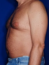 Male Abdominoplasty Before & After