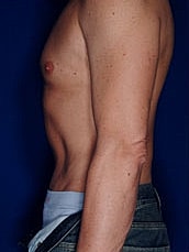 Male Abdominoplasty Before & After