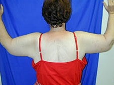 Brachioplasty Before & After