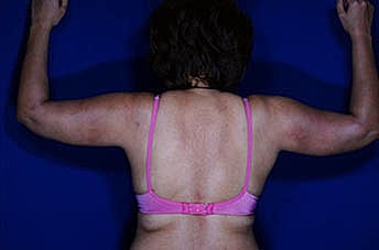Brachioplasty Before & After