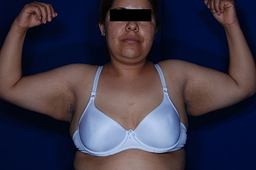 Brachioplasty Before & After