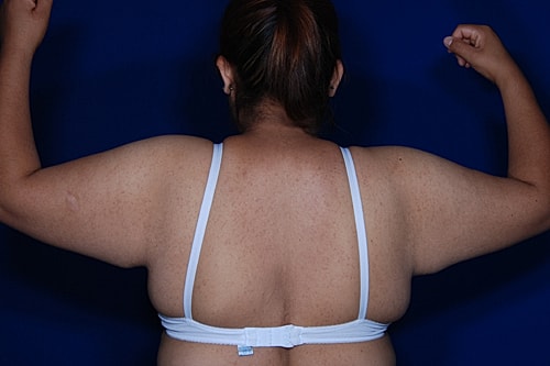 Brachioplasty Before & After