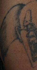 Tattoo Removal Before & After