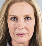 Sculptra Before & After