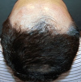 Light Therapy For Hair Growth Before & After