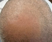Light Therapy For Hair Growth Before & After