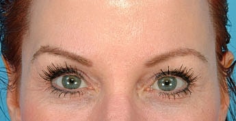 Eyebrow Transplants Before & After