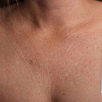 Non Surgical Skin Tightening Before & After