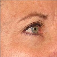 Non Surgical Skin Tightening Before & After