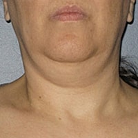 Non Surgical Skin Tightening Before & After