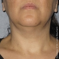 Non Surgical Skin Tightening Before & After