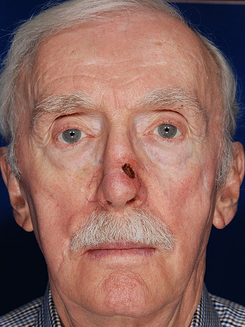 Skin Cancer Reconstruction Before & After