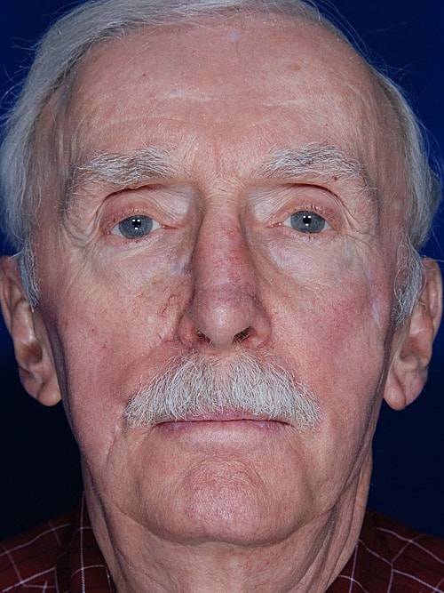 Skin Cancer Reconstruction Before & After