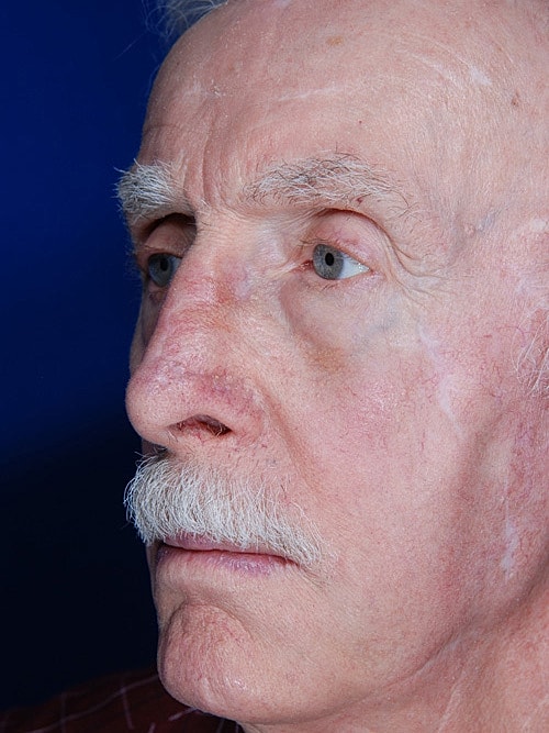 Skin Cancer Reconstruction Before & After