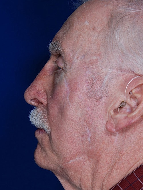 Skin Cancer Reconstruction Before & After