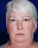 Skin Cancer Reconstruction Before & After