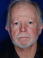 Skin Cancer Reconstruction Before & After