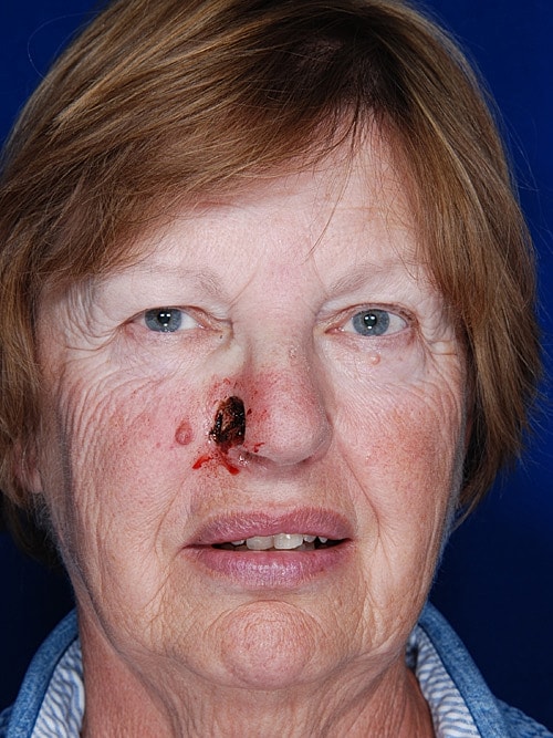 Skin Cancer Reconstruction Before & After