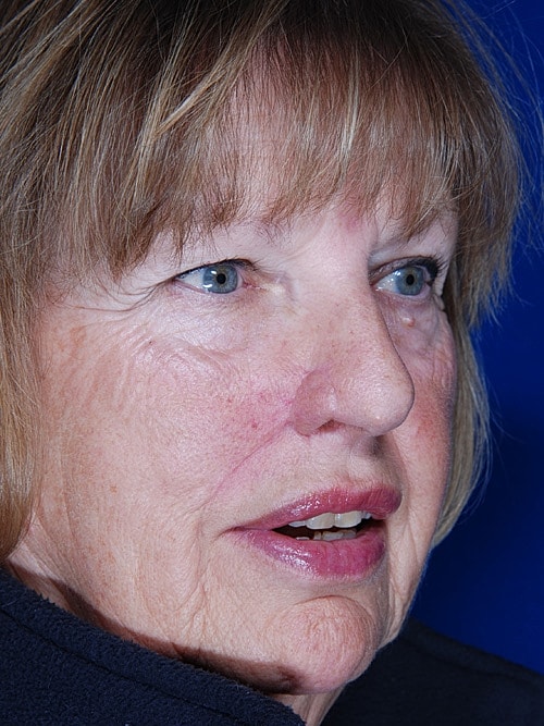 Skin Cancer Reconstruction Before & After