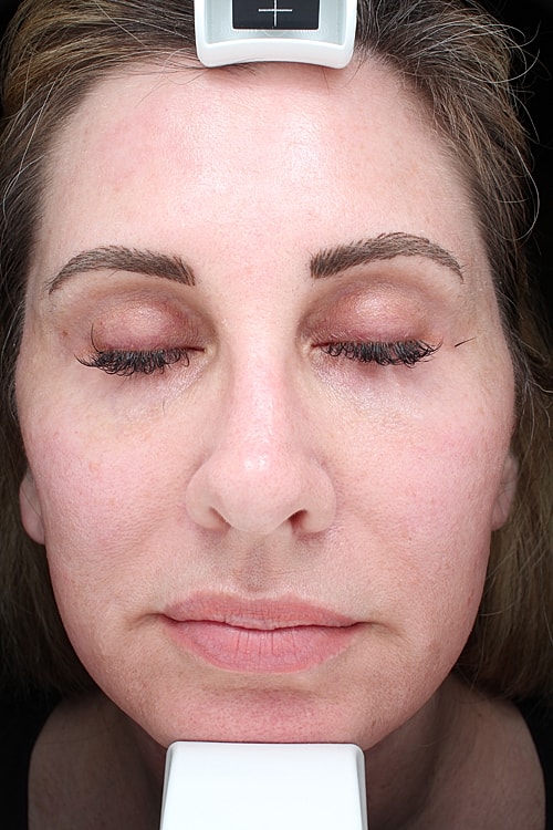 Facial Fat Transfer Before & After
