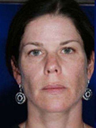 Facial Fat Transfer Before & After