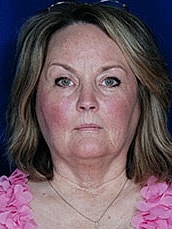 Facial Fat Transfer Before & After