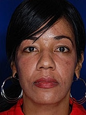 Facial Fat Transfer Before & After