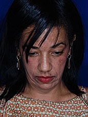 Facial Fat Transfer Before & After
