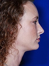 Facial Fat Transfer Before & After