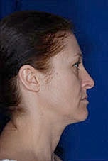 Facial Fat Transfer Before & After