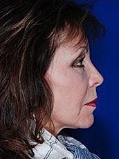 Facial Fat Transfer Before & After
