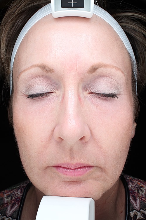 Facial Fat Transfer Before & After