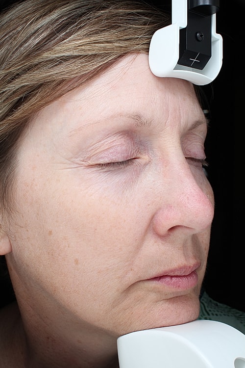 Facial Fat Transfer Before & After